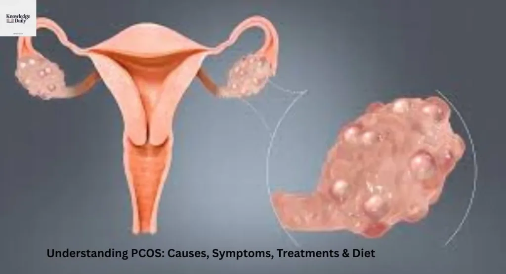 pcos