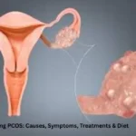 pcos
